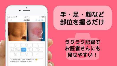 「アトピー治療見える化アプリ-アトピヨ」のスクリーンショット 1枚目