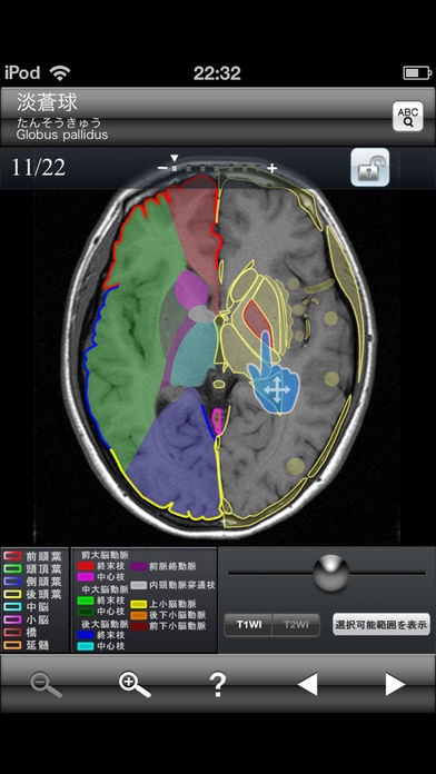 「断面図ウォーカー脳MRI」のスクリーンショット 2枚目