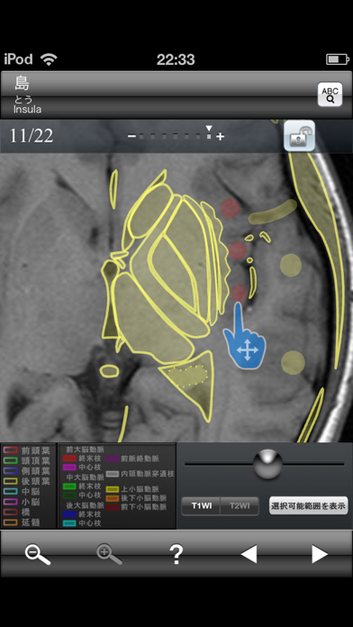 すぐわかる！】『断面図ウォーカー脳MRI』 - Appliv